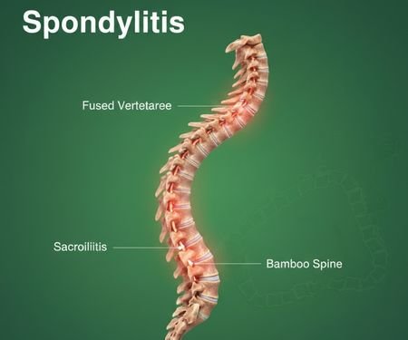Chiropractic Treatment for Spondylitis | Dr Hitesh Kamble | Adiyogi Multispecialist